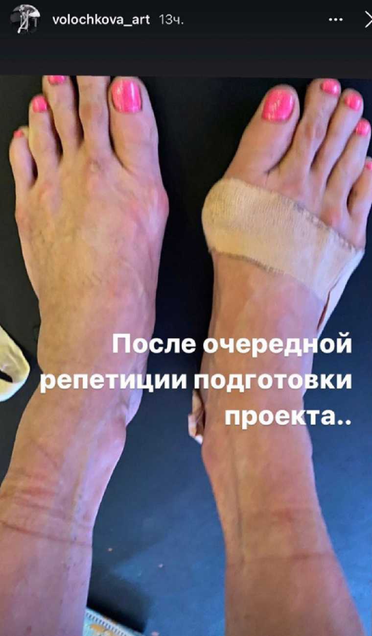 Изуродованные ноги Волочковой ужаснули фанатов. Фото